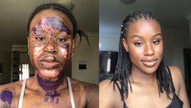 Gas explosion survivor shares photos showing her beautiful transformation in six months