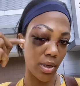 Olympian Kim Glass, Explain How She Got Att@cked By A Homeless Man, Shows Injur!es Infl!cted On Her