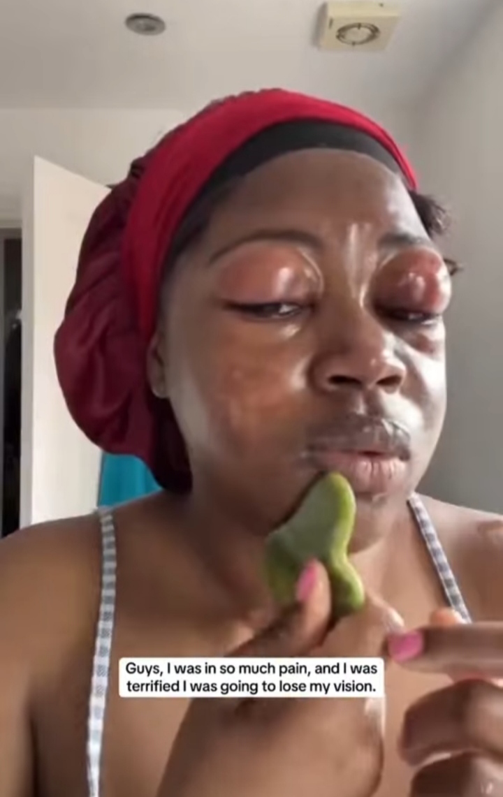 Lady shares how eyelids began to swell after using eyelash extensions